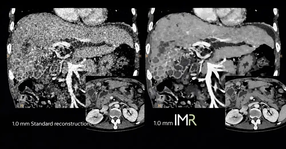 Снижение лучевой нагрузки на КТ: технология IMR для безопасности и четкости