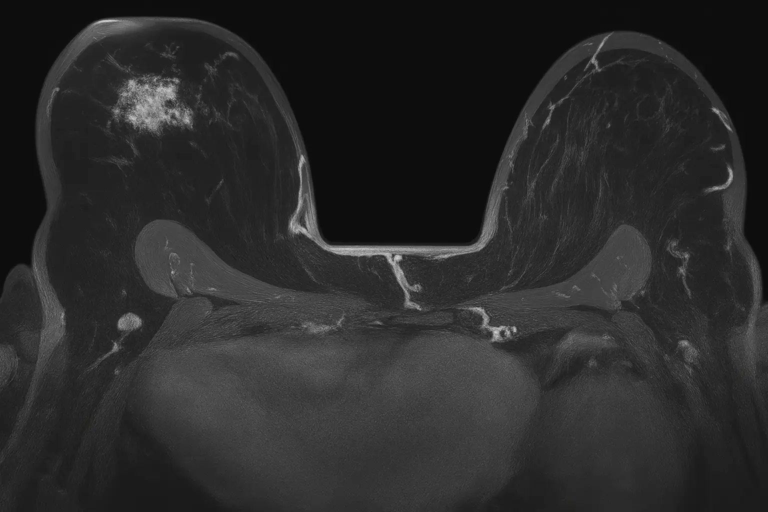МРТ молочных желез: ранняя диагностика онкологических заболеваний